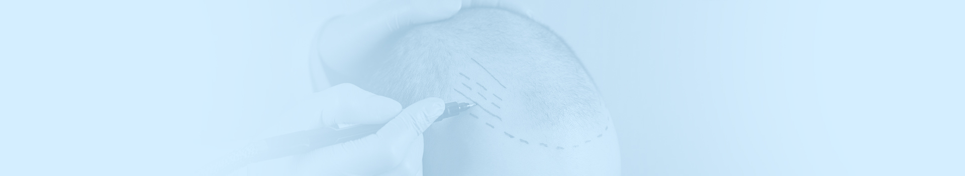 Hair transplant planning at Esencan Hospital in Istanbul
